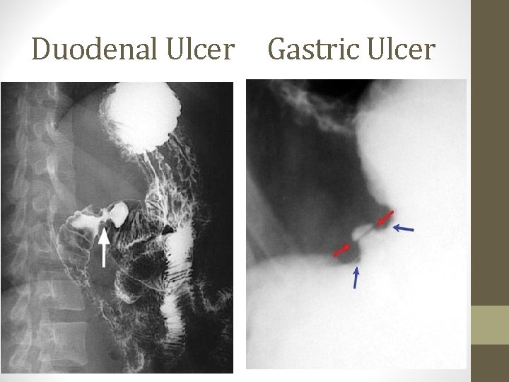 Duodenal Ulcer Gastric Ulcer 