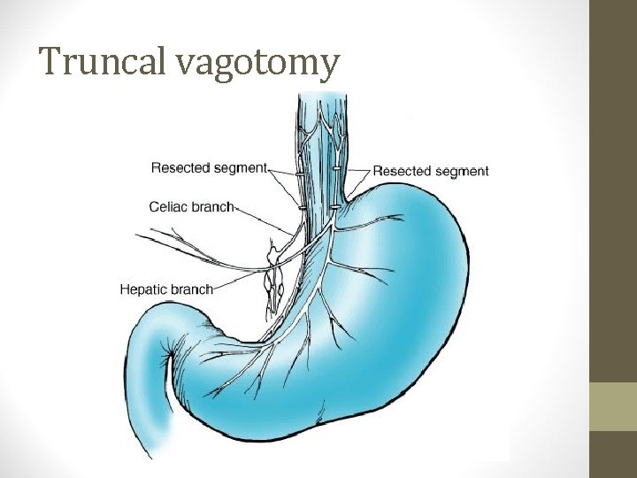 Truncal vagotomy 