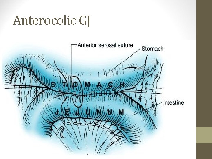 Anterocolic GJ 