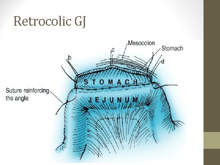 Retrocolic GJ 