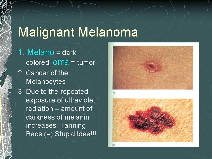 Malignant Melanoma 1. Melano = dark colored; oma = tumor 2. Cancer of the