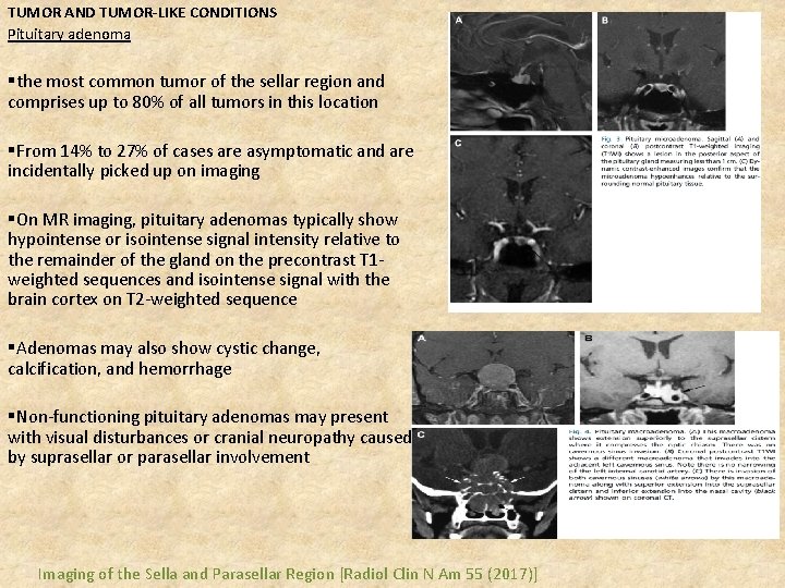 TUMOR AND TUMOR-LIKE CONDITIONS Pituitary adenoma §the most common tumor of the sellar region