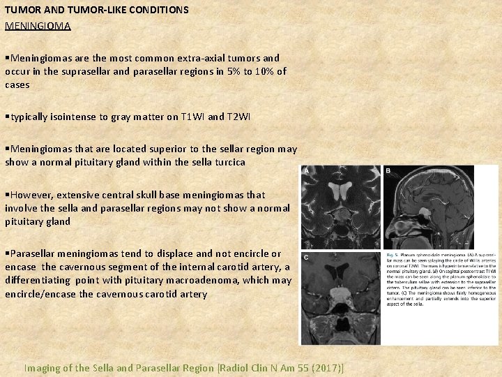 TUMOR AND TUMOR-LIKE CONDITIONS MENINGIOMA §Meningiomas are the most common extra-axial tumors and occur