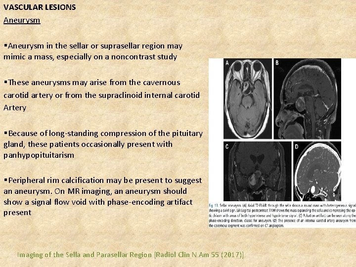VASCULAR LESIONS Aneurysm §Aneurysm in the sellar or suprasellar region may mimic a mass,