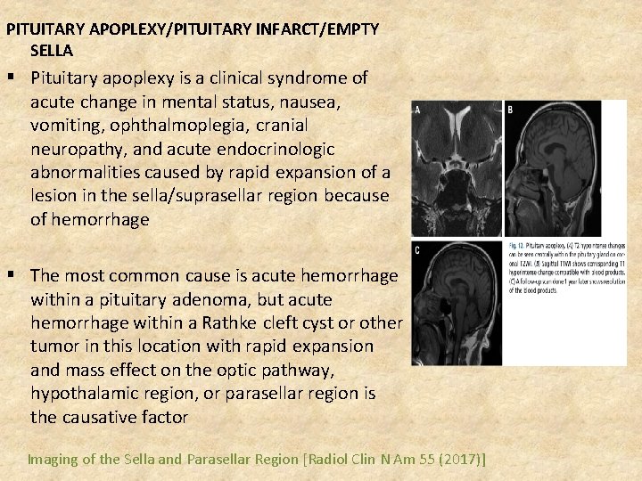 PITUITARY APOPLEXY/PITUITARY INFARCT/EMPTY SELLA § Pituitary apoplexy is a clinical syndrome of acute change