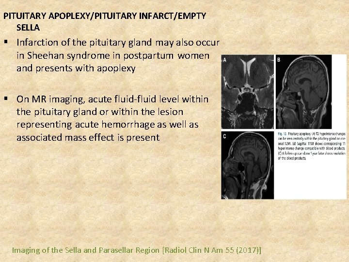 PITUITARY APOPLEXY/PITUITARY INFARCT/EMPTY SELLA § Infarction of the pituitary gland may also occur in