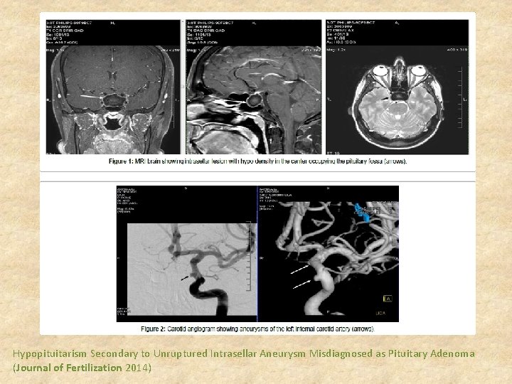 Hypopituitarism Secondary to Unruptured Intrasellar Aneurysm Misdiagnosed as Pituitary Adenoma (Journal of Fertilization 2014)
