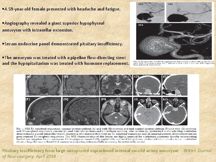 §A 59 -year-old female presented with headache and fatigue. §Angiography revealed a giant superior