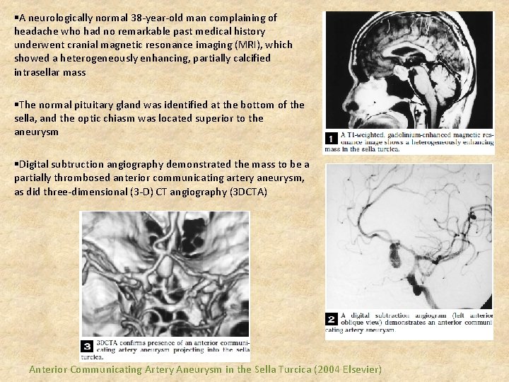 §A neurologically normal 38 -year-old man complaining of headache who had no remarkable past