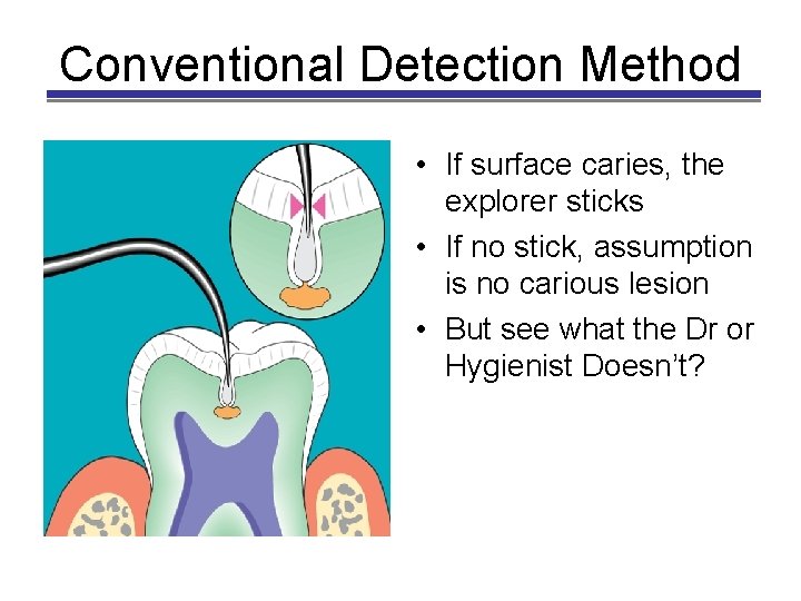 Conventional Detection Method • If surface caries, the explorer sticks • If no stick,