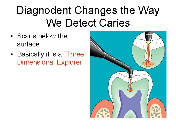 Diagnodent Changes the Way We Detect Caries • Scans below the surface • Basically