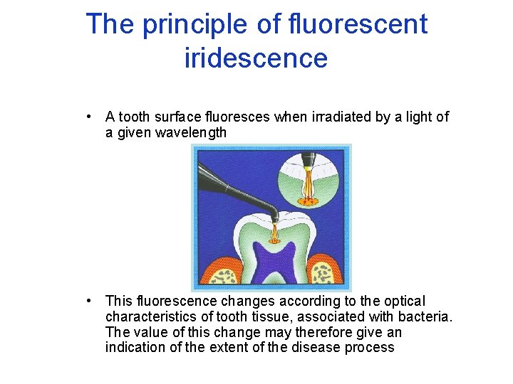 The principle of fluorescent iridescence • A tooth surface fluoresces when irradiated by a