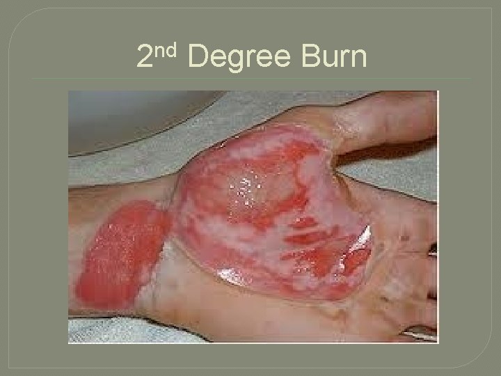 2 nd Degree Burn 