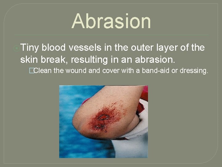 Abrasion ⦿Tiny blood vessels in the outer layer of the skin break, resulting in