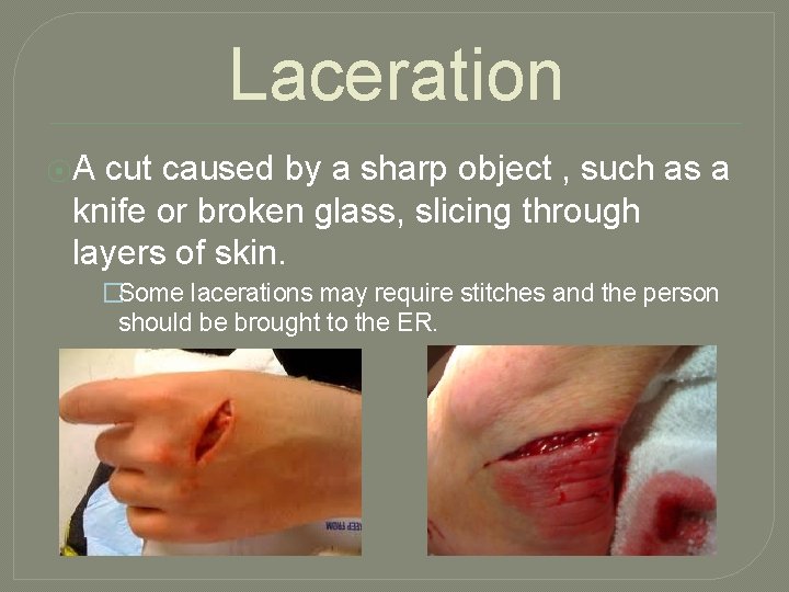 Laceration ⦿A cut caused by a sharp object , such as a knife or