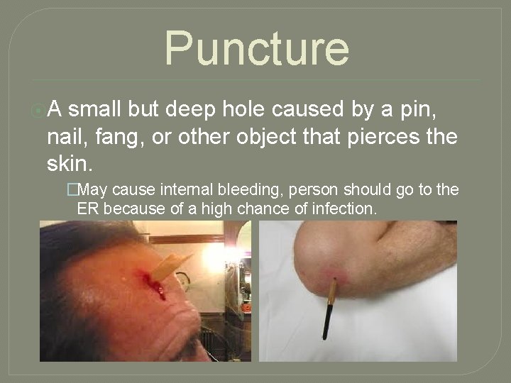 Puncture ⦿A small but deep hole caused by a pin, nail, fang, or other
