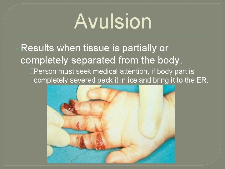 Avulsion ⦿Results when tissue is partially or completely separated from the body. �Person must