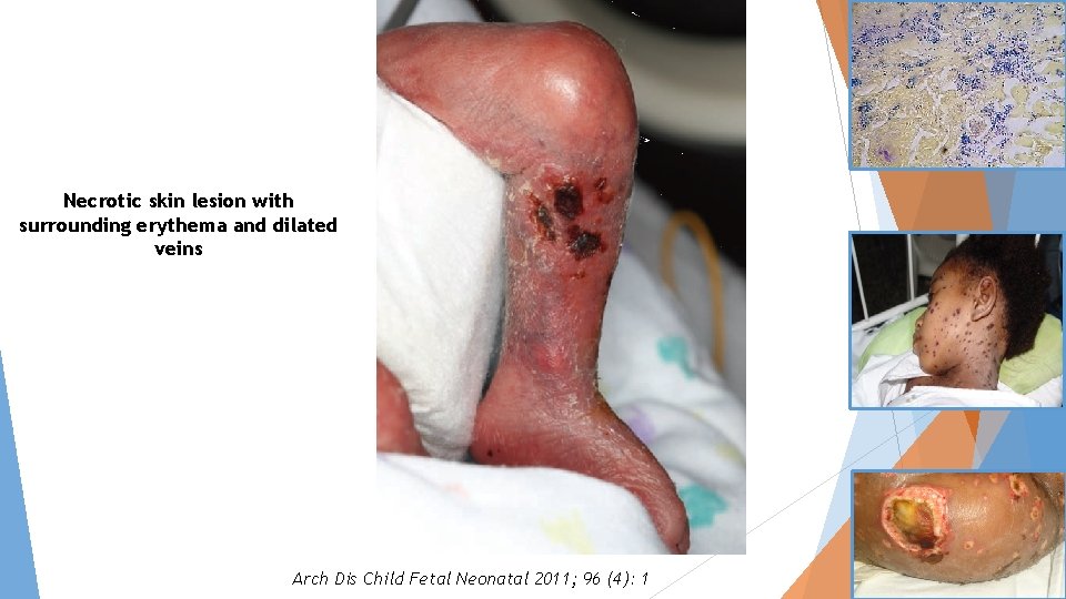 Necrotic skin lesion with surrounding erythema and dilated veins Arch Dis Child Fetal Neonatal