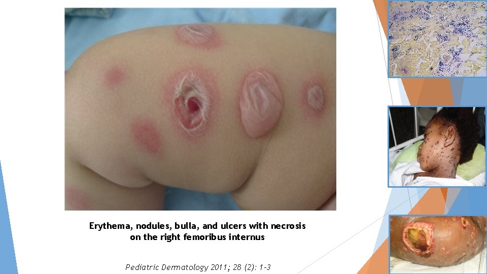 Erythema, nodules, bulla, and ulcers with necrosis on the right femoribus internus Pediatric Dermatology