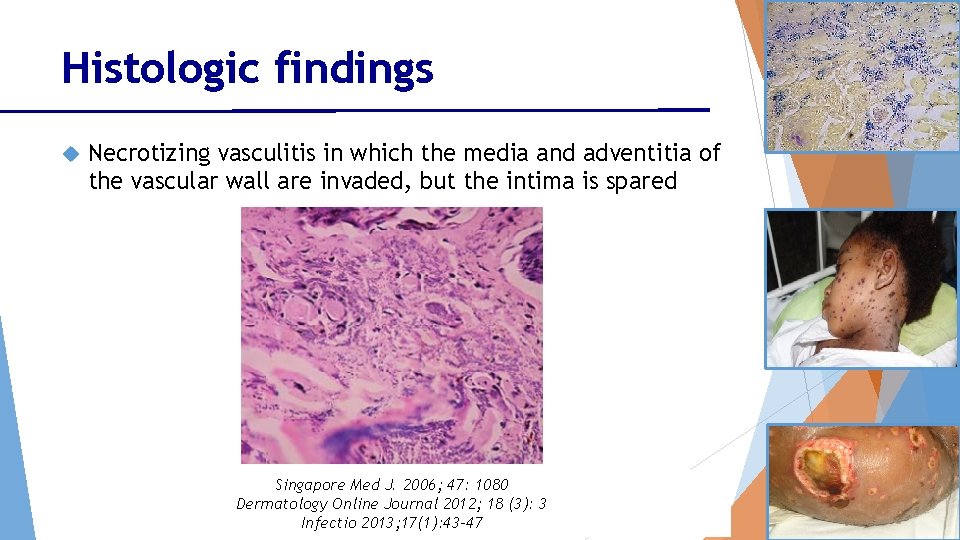 Histologic findings Necrotizing vasculitis in which the media and adventitia of the vascular wall