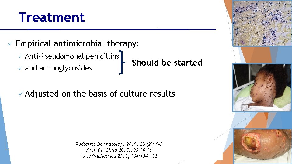 Treatment ü Empirical antimicrobial therapy: ü Anti-Pseudomonal penicillins ü and aminoglycosides ü Adjusted Should