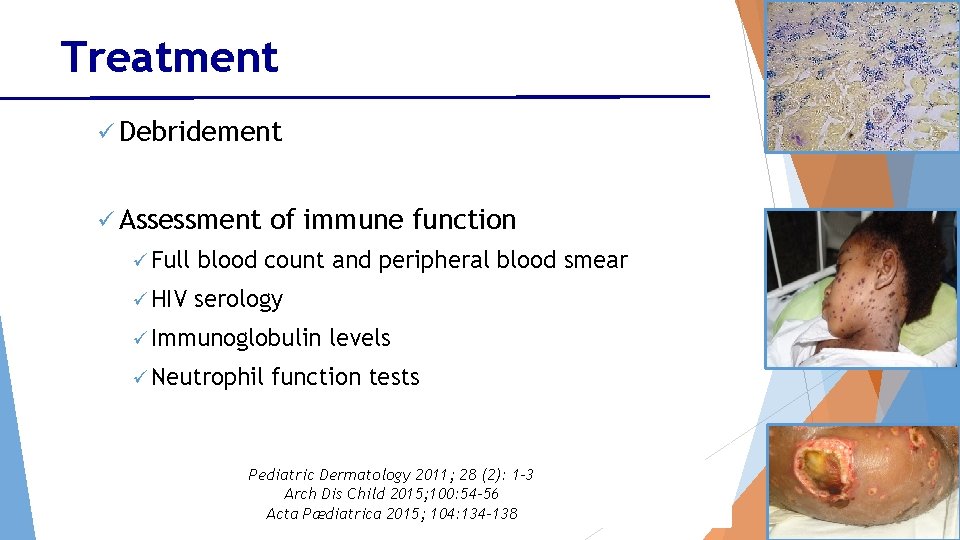 Treatment ü Debridement ü Assessment of immune function ü Full blood count and peripheral