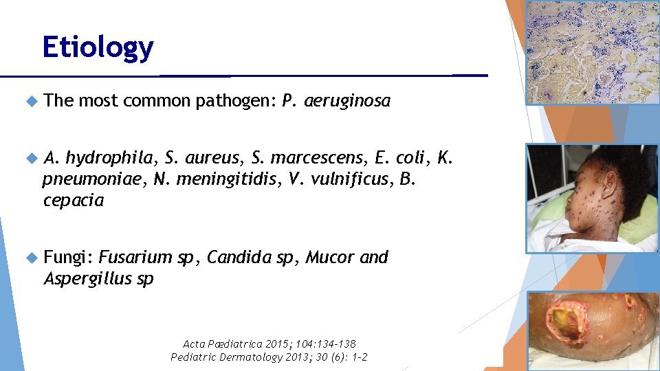 Etiology The most common pathogen: P. aeruginosa A. hydrophila, S. aureus, S. marcescens, E.