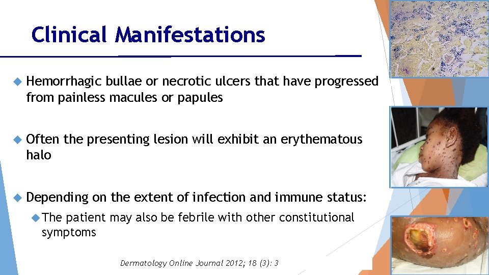 Clinical Manifestations Hemorrhagic bullae or necrotic ulcers that have progressed from painless macules or