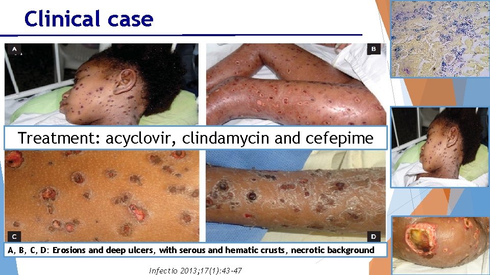 Clinical case Girl: 5 years old Initially presented chickenpox and then infection with S.