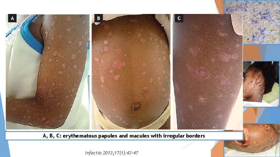 A, B, C: erythematous papules and macules with irregular borders Infectio 2013; 17(1): 43–