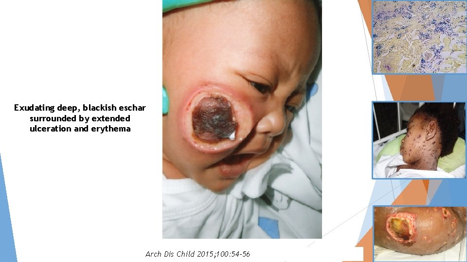 Exudating deep, blackish eschar surrounded by extended ulceration and erythema Arch Dis Child 2015;