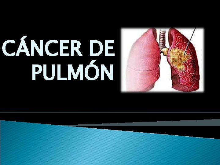 CÁNCER DE PULMÓN 