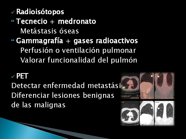 ü Radioisótopos Tecnecio + medronato Metástasis óseas Gammagrafía + gases radioactivos Perfusión o ventilación