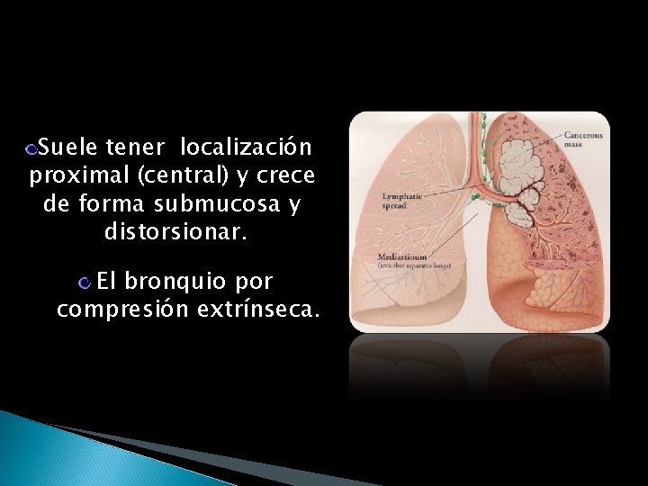 Suele tener localización proximal (central) y crece de forma submucosa y distorsionar. El bronquio