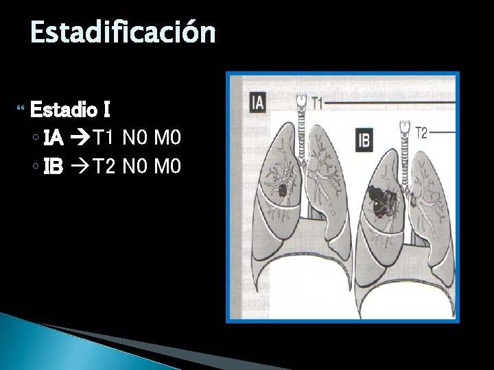 Estadificación Estadio I ◦ IA T 1 N 0 M 0 ◦ IB T