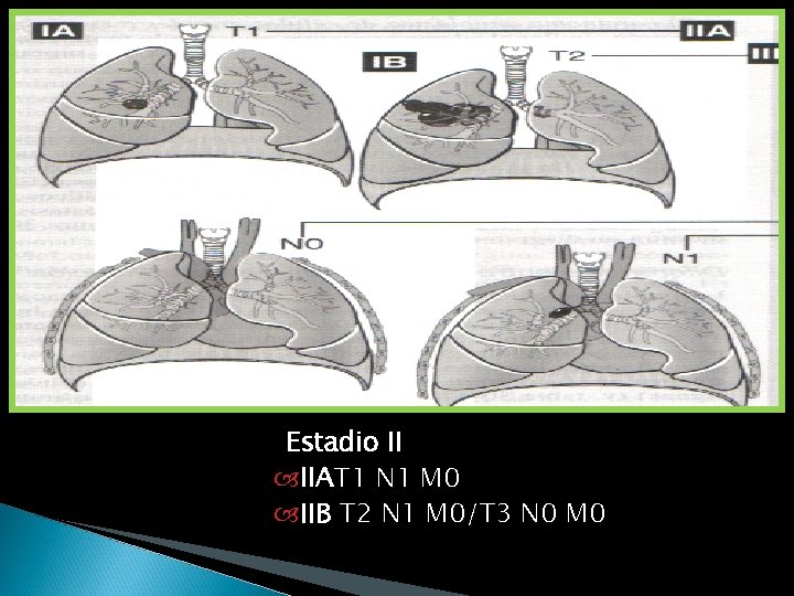 Estadio II IIAT 1 N 1 M 0 IIB T 2 N 1 M