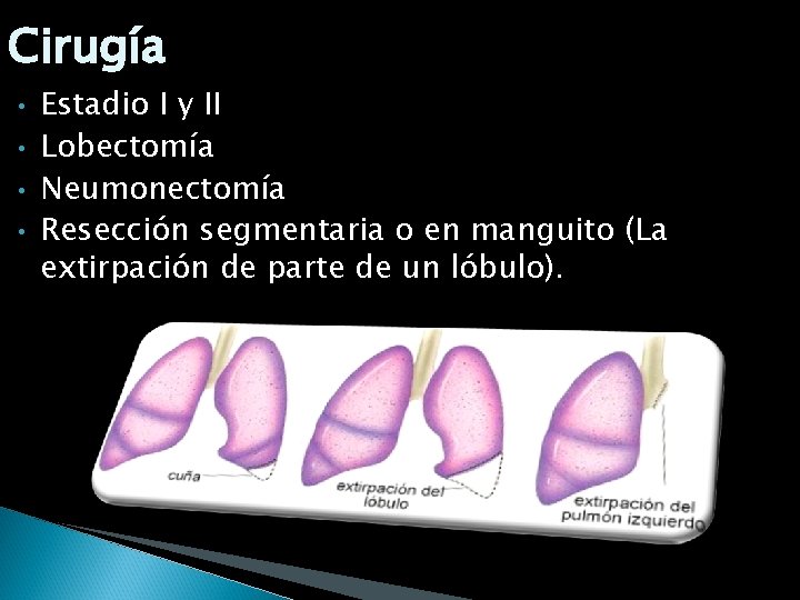 Cirugía • • Estadio I y II Lobectomía Neumonectomía Resección segmentaria o en manguito