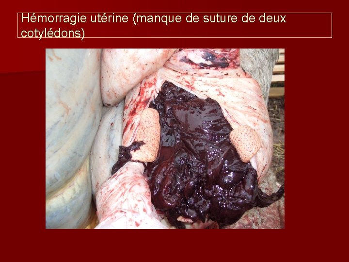 Hémorragie utérine (manque de suture de deux cotylédons) 