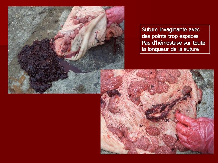 Suture invaginante avec des points trop espacés Pas d’hémostase sur toute la longueur de