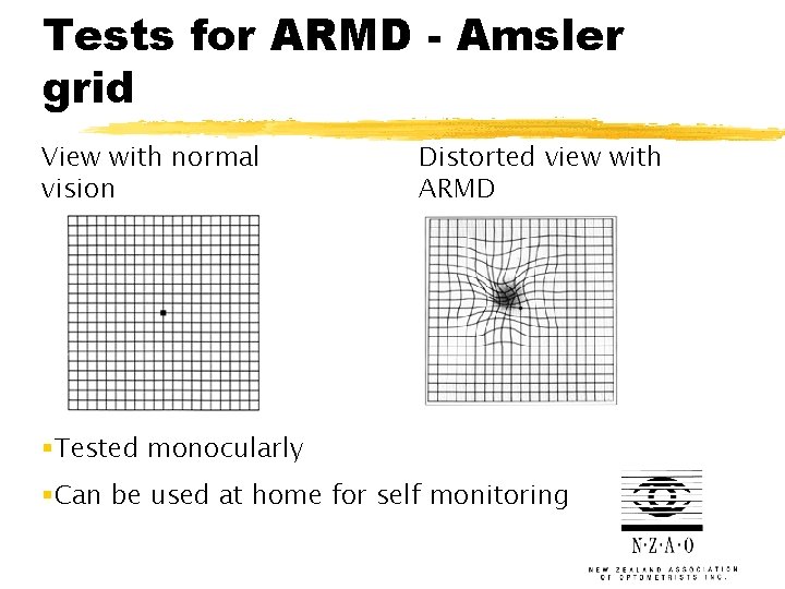 Tests for ARMD - Amsler grid View with normal vision Distorted view with ARMD