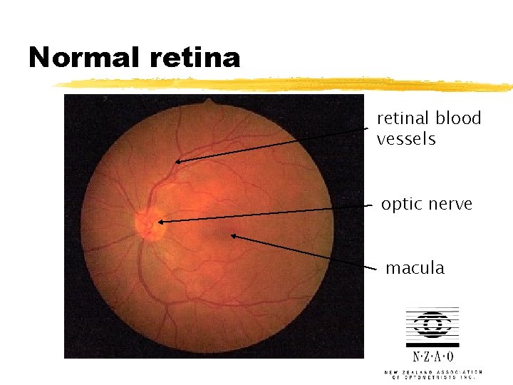 Normal retinal blood vessels optic nerve macula 