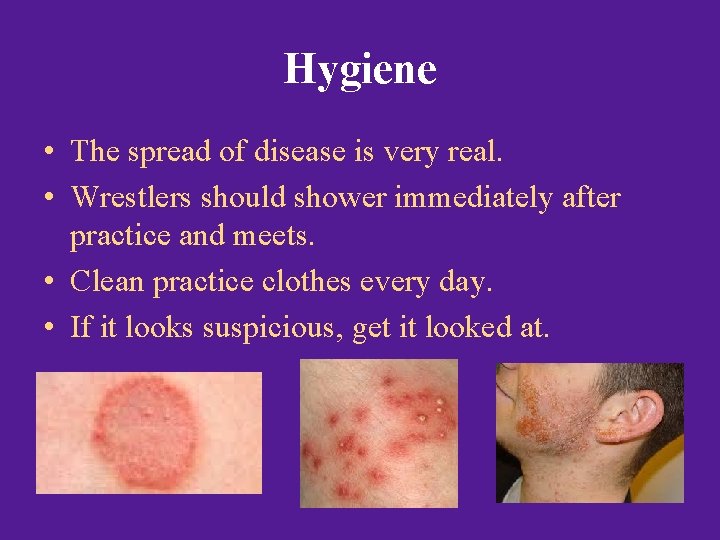 Hygiene • The spread of disease is very real. • Wrestlers should shower immediately