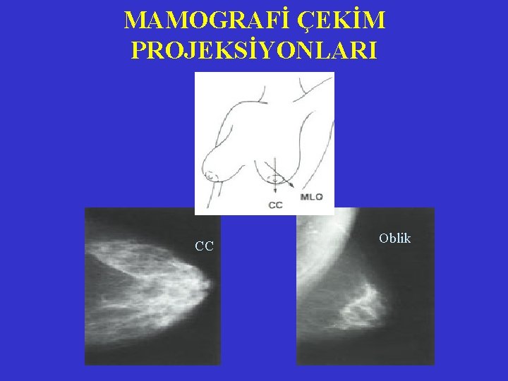 MAMOGRAFİ ÇEKİM PROJEKSİYONLARI CC Oblik MAMOGRAFİ ÇEKİM PROJEKSİYONLARI CC Oblik