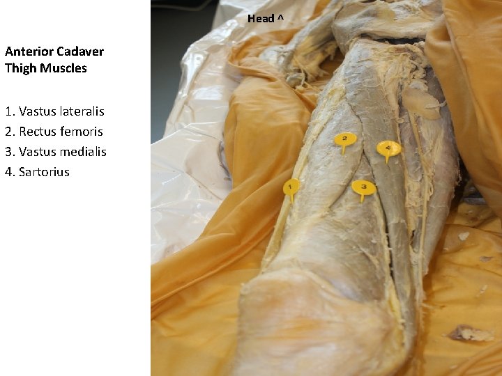 Hip Anterior Cadaver Thigh Muscles 1 Sartorius 2