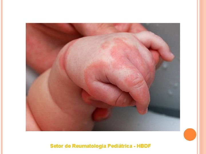 Setor de Reumatologia Pediátrica - HBDF 