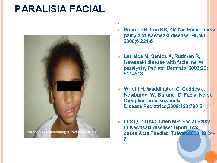 PARALISIA FACIAL. Serviço de Reumatologia Pediátrica HBDF Ø Poon LKH, Lun KS, YM Ng.