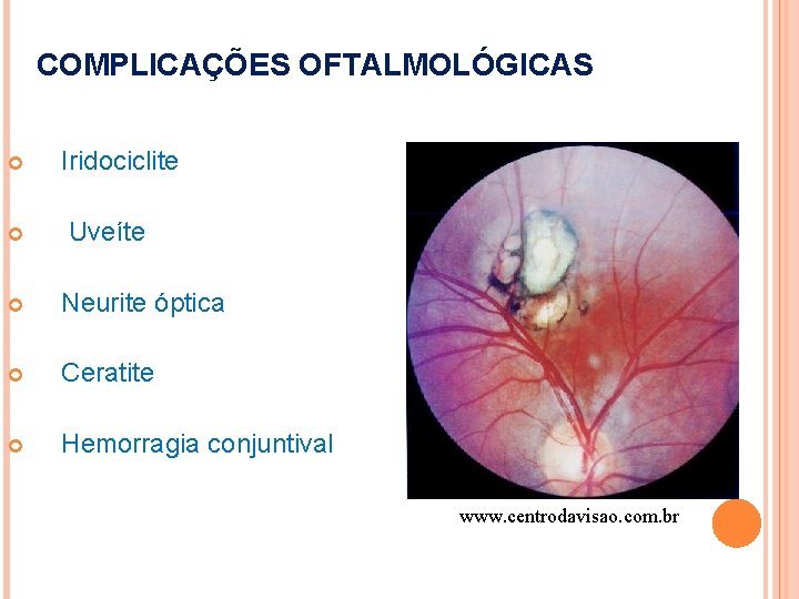 COMPLICAÇÕES OFTALMOLÓGICAS Iridociclite Uveíte Neurite óptica Ceratite Hemorragia conjuntival www. centrodavisao. com. br 