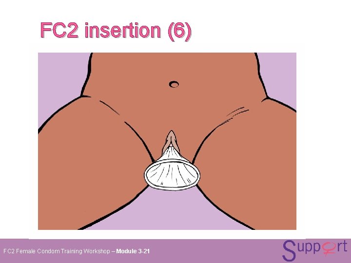 FC 2 insertion (6) FC 2 Female Condom Training Workshop – Module 3 -21 FC 2 insertion (6) FC 2 Female Condom Training Workshop – Module 3 -21