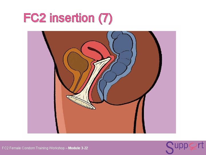 FC 2 insertion (7) FC 2 Female Condom Training Workshop – Module 3 -22 FC 2 insertion (7) FC 2 Female Condom Training Workshop – Module 3 -22
