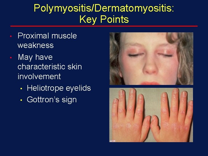 Polymyositis/Dermatomyositis: Key Points • • Proximal muscle weakness May have characteristic skin involvement •